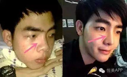 男网红整容脸吃瓜图片,吃瓜群众热议男网红变脸之谜